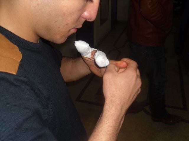 Kurşun Elinde Patladı Parmağı Kopdu